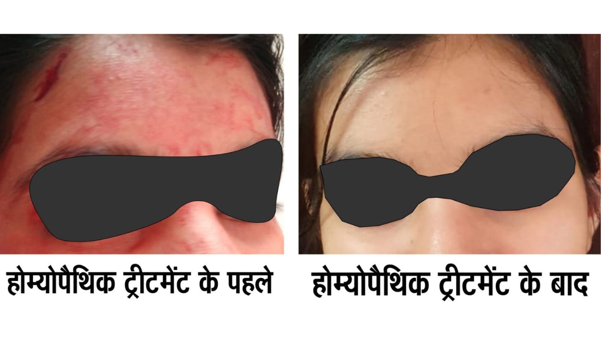 Rare disease Blood-Sweating Disorder Successfully Treated with Advanced Homeopathy – Dr AK dwivedi